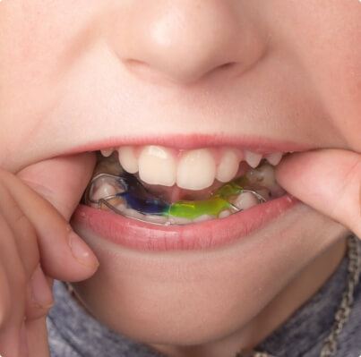 Closeup of dental patient placing an orthodontic appliance for bite adjustment