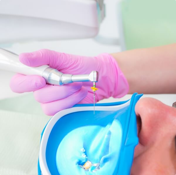 Dentist performing root canal treatment