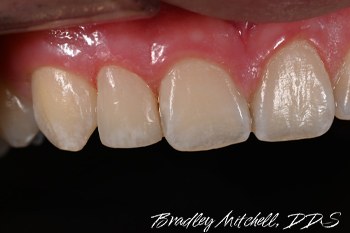 Smile with small tooth repaired with dental bonding