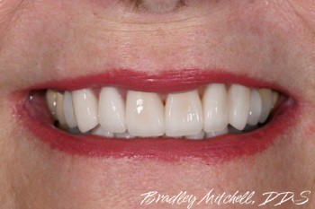 Smile alignment corrected with veneers and dental crowns