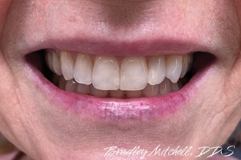 Flawless smile after fillings were replaced