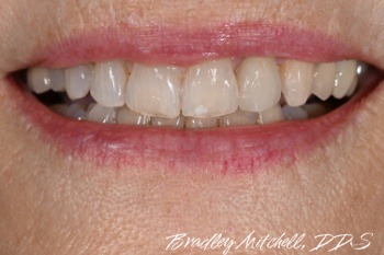 Smile after dental crown is replaced