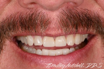 Perfected smile after treatment with Invisalign and veneers