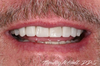 Bright attractive smile with veneers