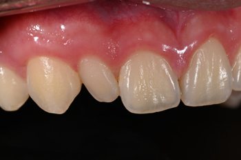 Smile with tooth that didn't develop the same size as others