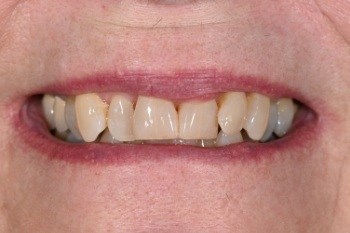 Smile with some crooked and misaligned teeth