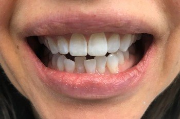 Crooked teeth before Invisalign treatment