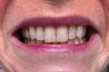 Stained and discolored teeth caused by failed fillings