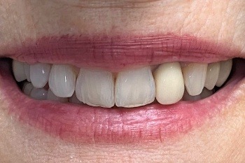 Smile with unnatural looking dental crown