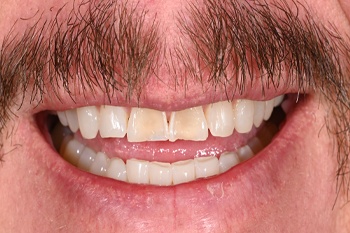Misaligned and discolored teeth before Invisalign and veneers