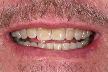 Stained teeth before treatment with veneers