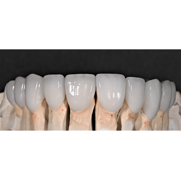 Model smile with custom veneers