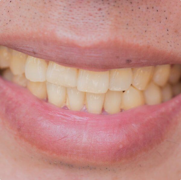 Closeup of smile with discoloration before teeth whitening