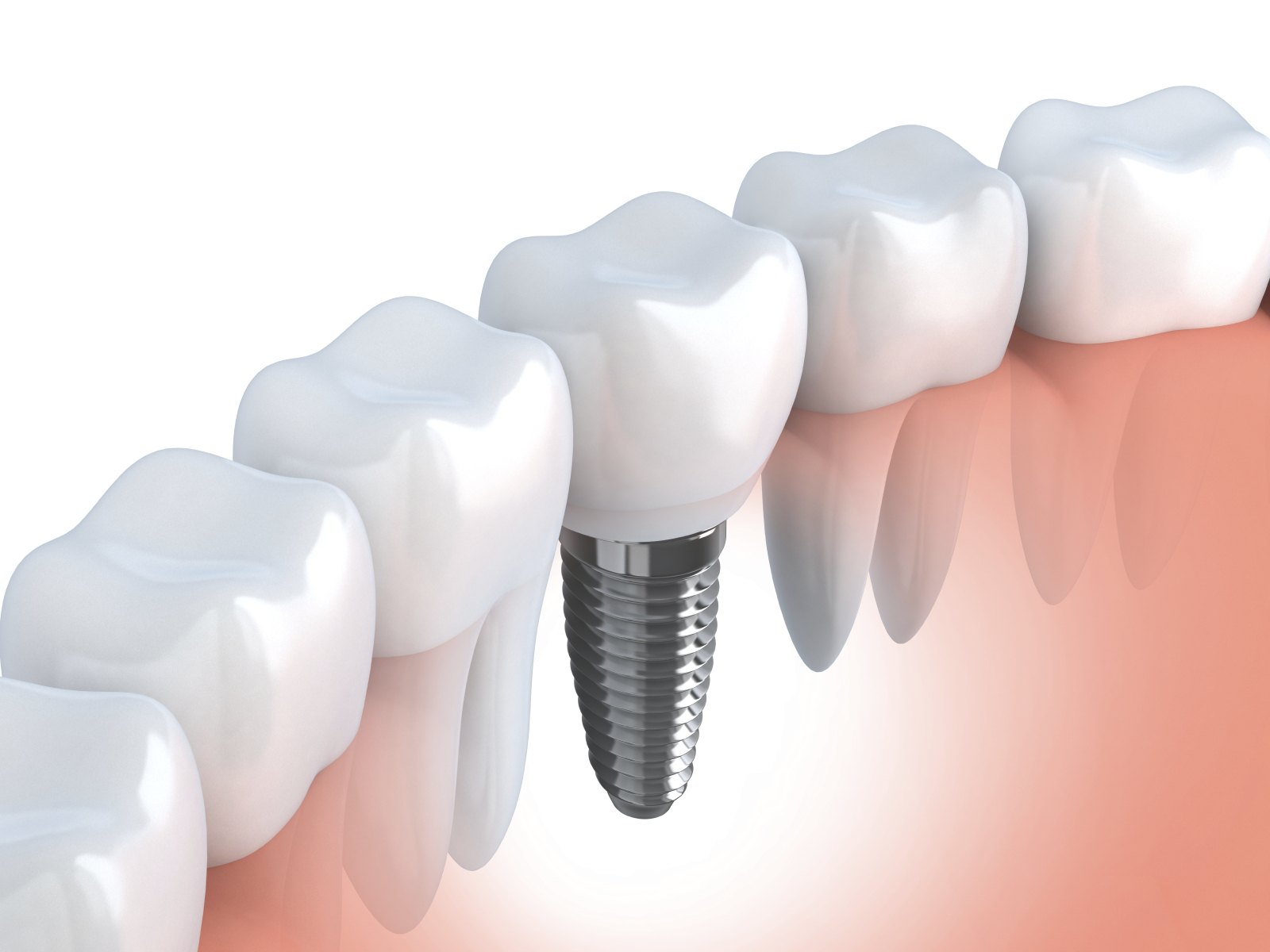 Oklahoma City dentist Dr. Mitchell restores smiles by replacing missing teeth. 