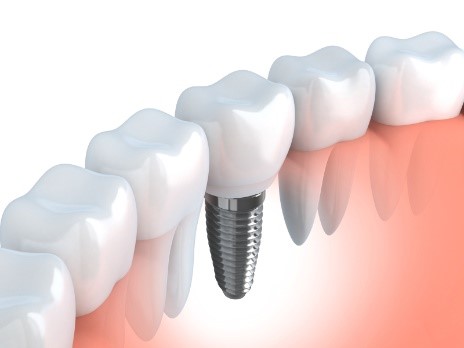 Get a complete smile with dental implants from your dentist in OKC.