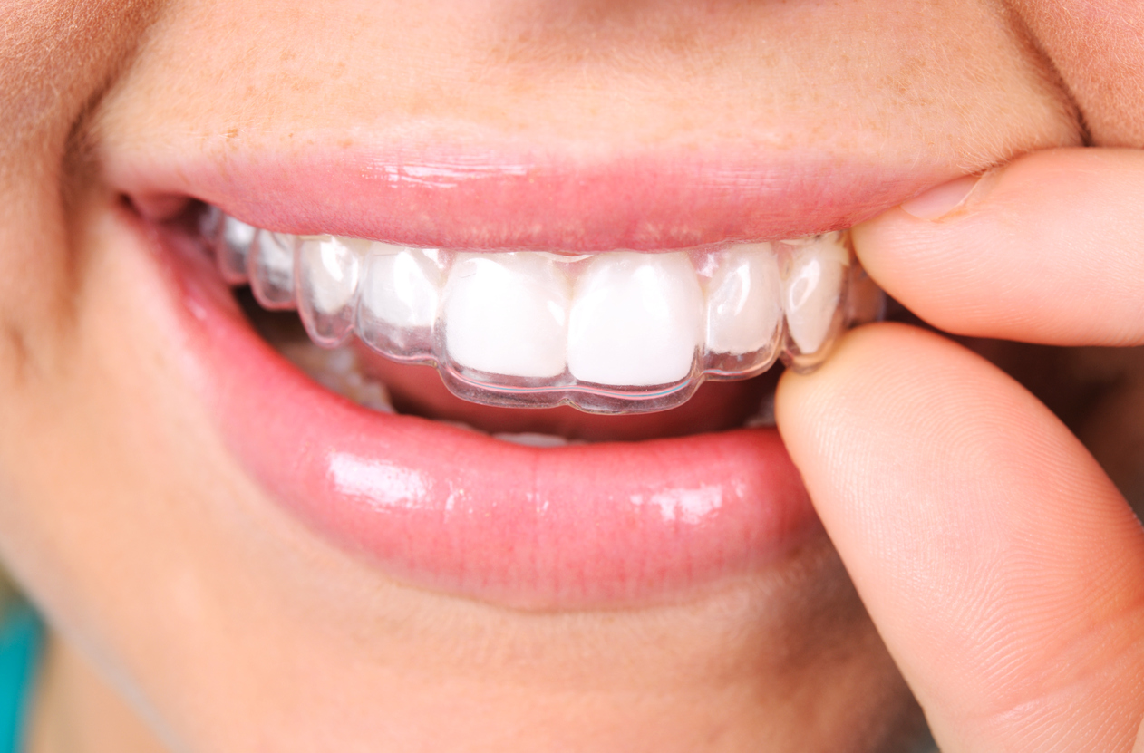 Have you considered discussing Invisalign with your dentist in OKC?