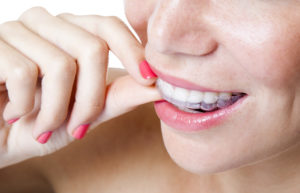 woman smiling clear braces 