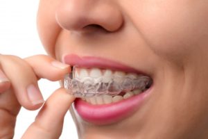 A woman removing a clear aligner.