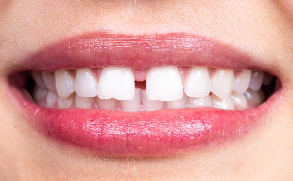 Woman's smile with tooth gap